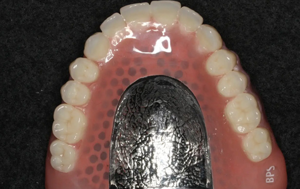 アタッチメント義歯/インプラント義歯