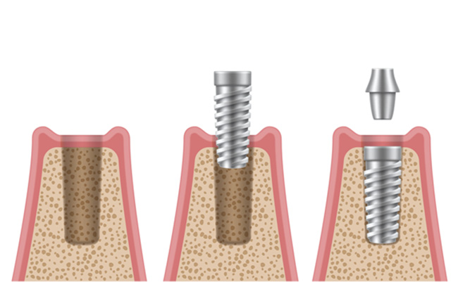 3．アバットメント（支台）の装着